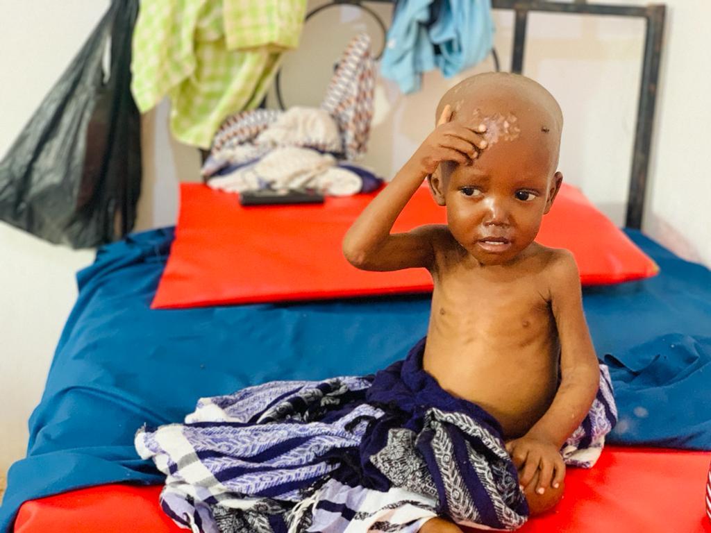 Figure 1 When Adan Kher was admitted to the Bayhaaw Stabilization Center in Baidoa, he suffered from the effects of kwashiorkor. The symptoms include swollen stomachs, peeling skin, and emaciated limbs.